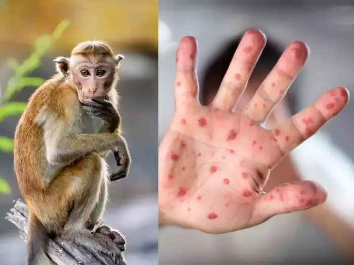 Monkeypox Virus का नाम सुनते ही डरे नहीं, जानें इसके लक्षण और सामान्य जानकारी